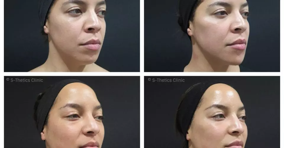 Patient Success Story – treating identical twins with Juvederm Volux & Voluma facial fillers