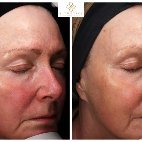 S-Thetics 6-Week Skin Transformation