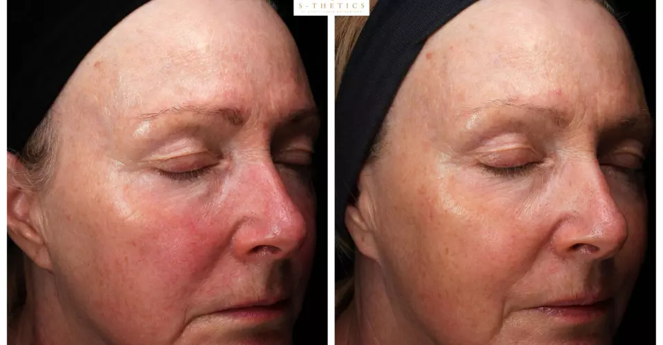 S-Thetics 6-Week Skin Transformation