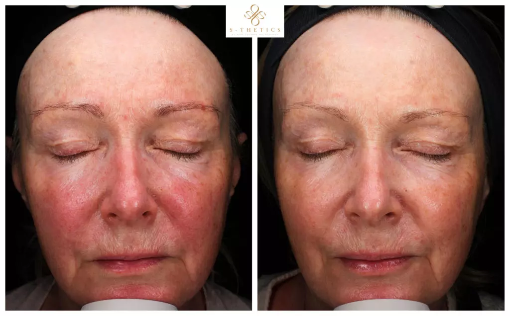 before-and-after-results-at-S-Thetics-Skin-Clinic-in-Beaconsfield-healthy-skin-reduce-facial-redness