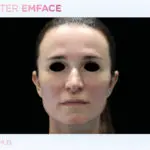 emface-before-and-after-at-s-thetics-clinic-in-beaconsfield8