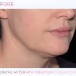 emface-before-and-after-at-s-thetics-clinic-in-beaconsfield7