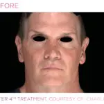 emface-before-and-after-at-s-thetics-clinic-in-beaconsfield7