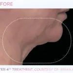 emface-before-and-after-at-s-thetics-clinic-in-beaconsfield7