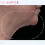 emface-before-and-after-at-s-thetics-clinic-in-beaconsfield8