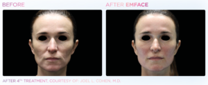 emface-before-and-after-photos-at-s-thetics-clinic-in-beaconsfield-buckinghamshire3