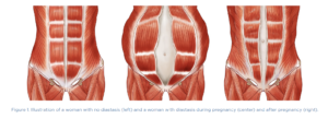 EMSCULPT NEO treatment for diastasis recti post-pregnancy at S-Thetics Clinic