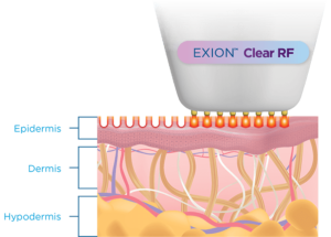BTL-Exion-Clear-RF-launches-at-S-Thetics-Clinic-in-Beaconsfield-clear-skin7