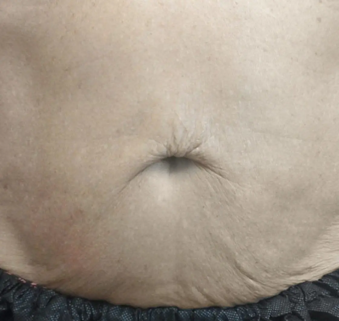 exion-body-abdomen-male-019-after