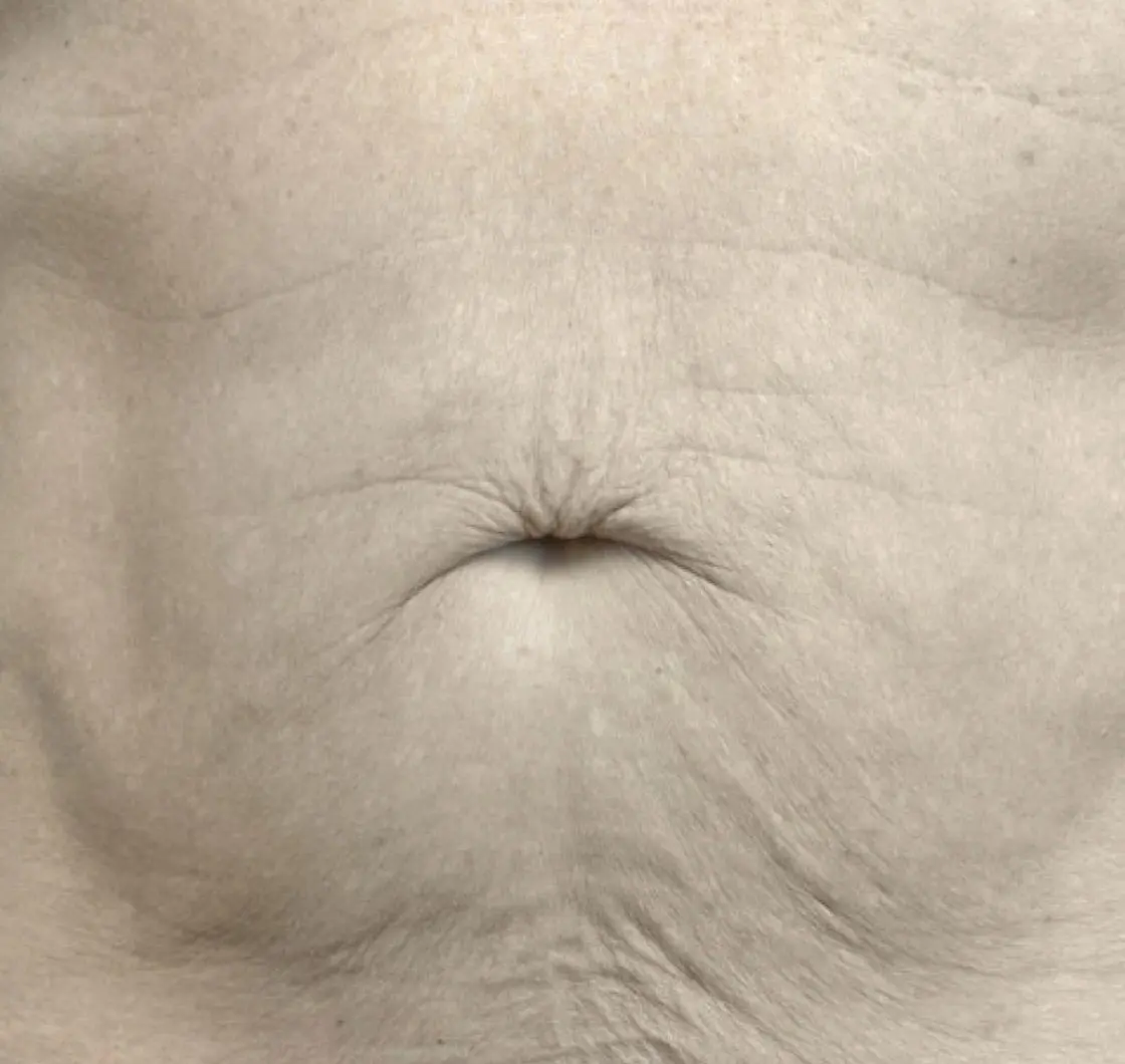 exion-body-abdomen-male-019-before