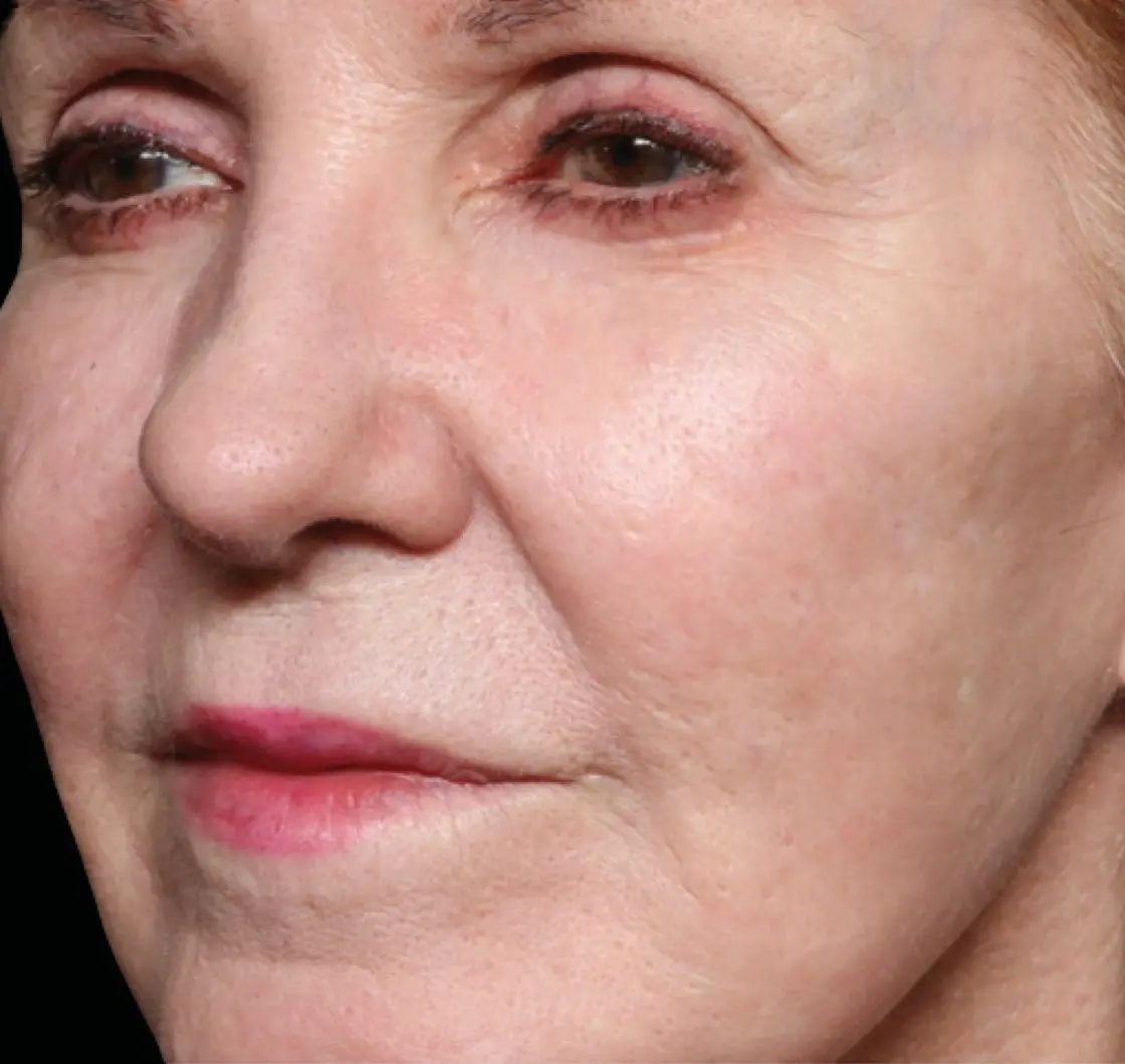 exion-face-cheek-female-004-after