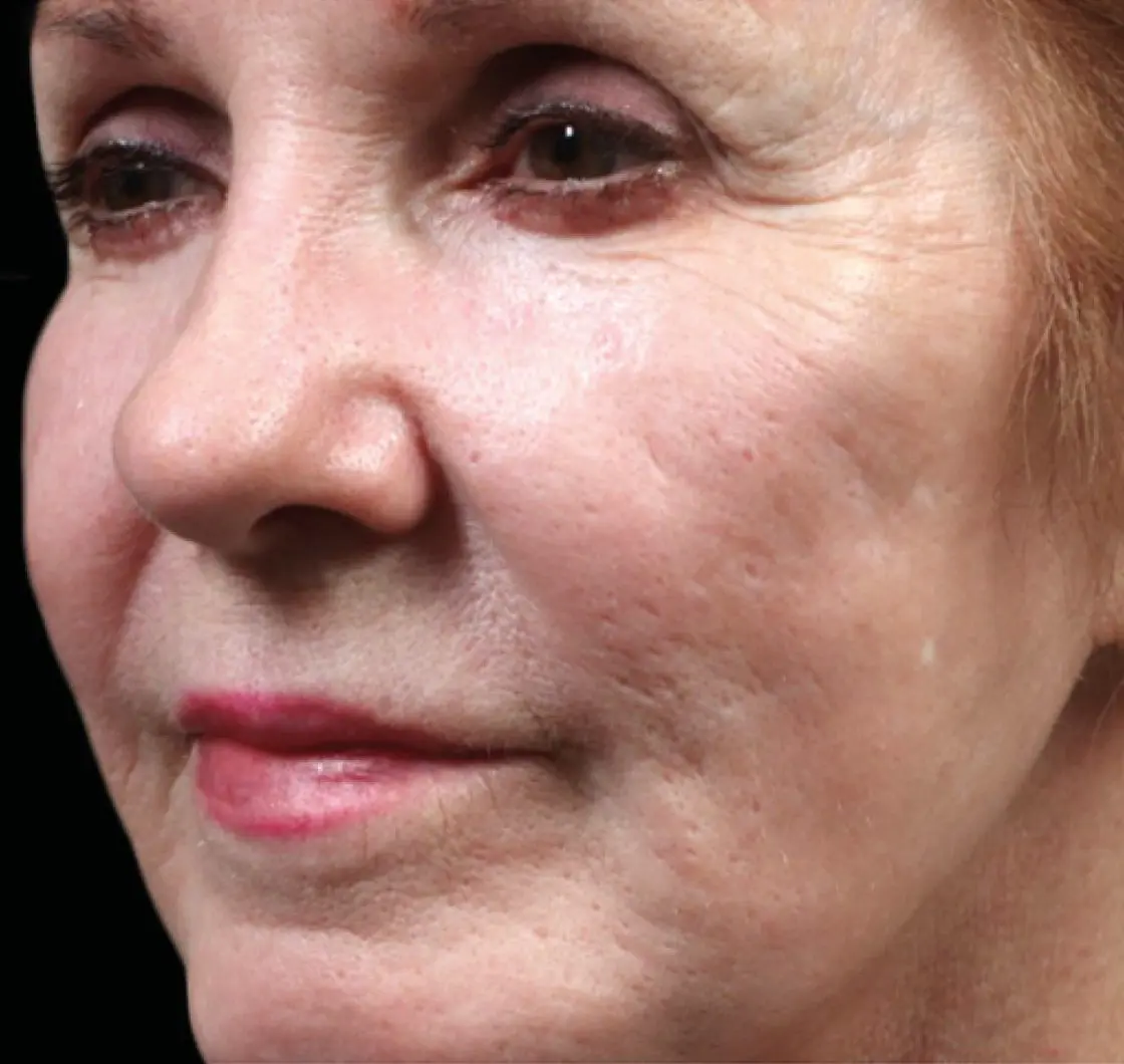 exion-face-cheek-female-004-before