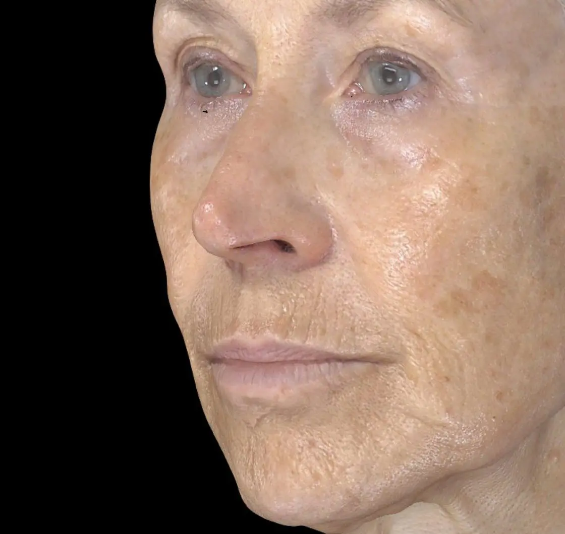 Exion-clear-rf-S-Thetics-Clinic-before
