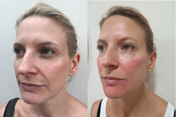 Dermal Fillers – patient experience