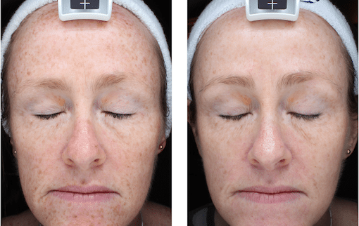 Skin Treatments – Patient Success Story