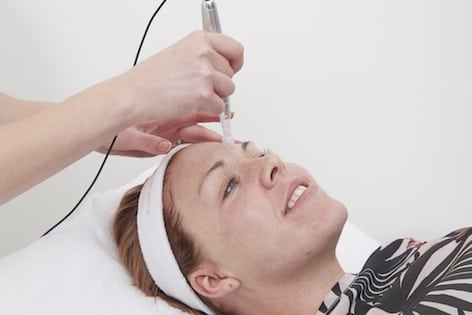 medical microneedling at S-Thetics Clinic, Beaconsfield