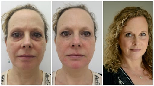 dermal-filler-buckinghamshire