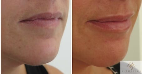Lip enhancement at S-Thetics – Patient success story