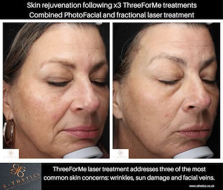 Patient Success Story – Combination Laser Treatment for Skin Rejuvenation