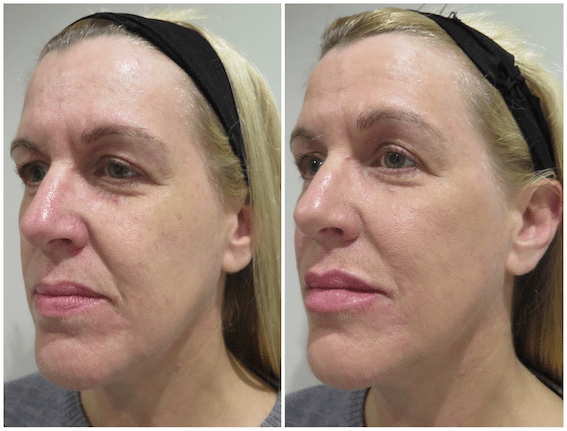Patient Success Story – Facial Filler Treatment