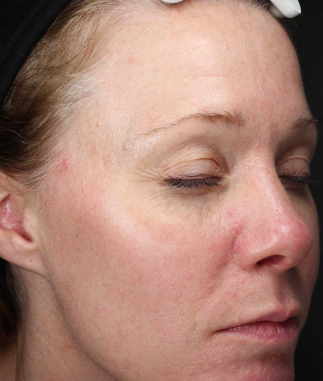 reduce-facial-redness-at-S-Thetics-Skin-Clinic