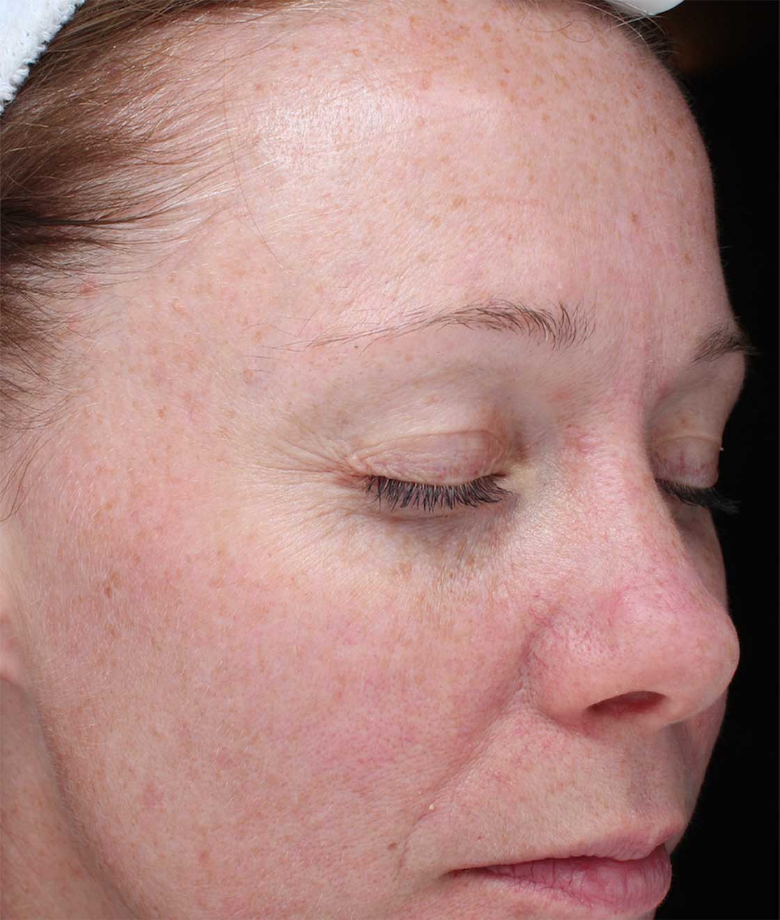 reduce-facial-redness-at-S-Thetics-Skin-Clinic