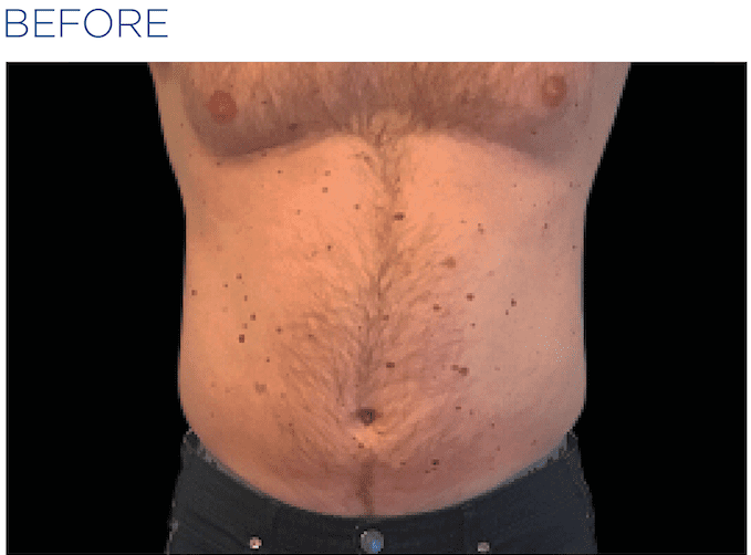 EMSculpt-before-and-after-S-Thetics-Aesthetic-Clinic-in-Beaconsfield-Buckinghamshire