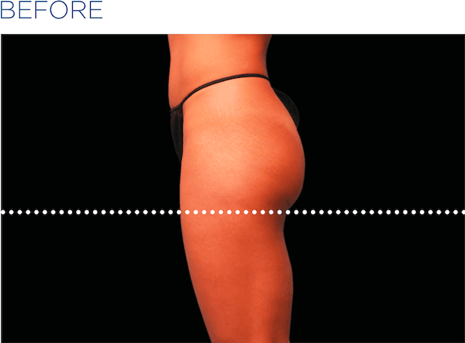 BTL-EMSculpt-non-surgical-buttock-lift-available-at-S-Thetics-Aesthetic-Clinic-in-Beaconsfield-Buckinghamshire