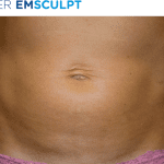 EMSculpt-before-and-after-S-Thetics-Aesthetic-Clinic-in-Buckinghamshire