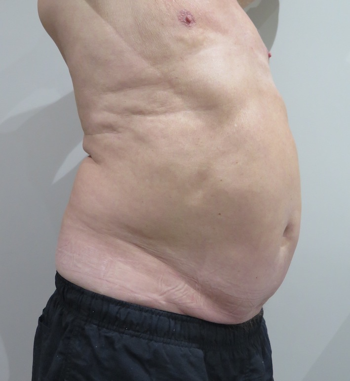 EMSculpt-before-and-after-S-Thetics-Aesthetic-Clinic-in-Buckinghamshire