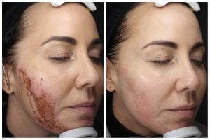 S-Thetics-Clinic-managing-chemical-peel-complications-from-external-practitioner