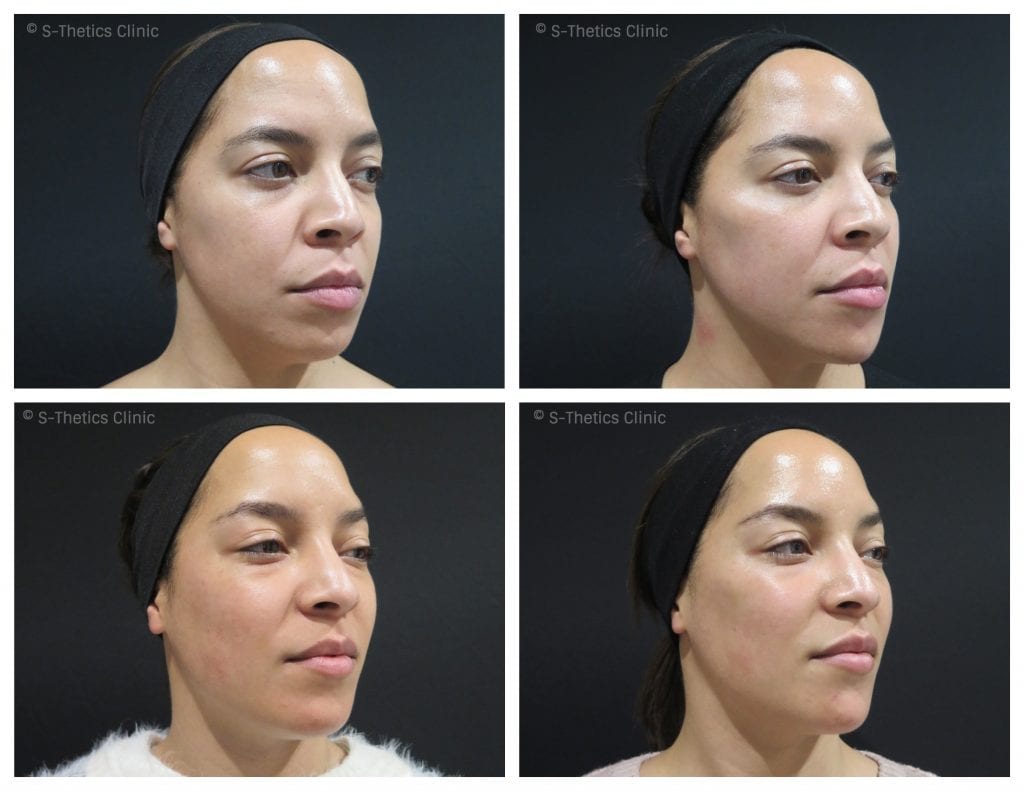 Patient Success Story treating identical twins with Juvederm Volux