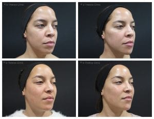 Treating-twins-with-Juvederm-Volux-and-Voluma-at-S-Thetics-Clinic