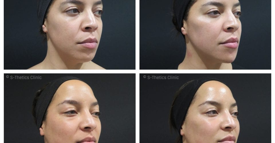 Patient Success Story – treating identical twins with Juvederm Volux & Voluma facial fillers