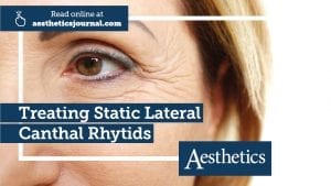 Miss Sherina Balaratnam Aesthetics Journal Expert Opinion Treating Static Lateral Canthal Rhytids Crows Feet