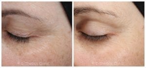 crows feet reduction at S-Thetics Clinic