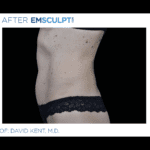 EMSCULPT-NEO-before-and-after-at-S-Thetics-Clinic-in-Beaconsfield-