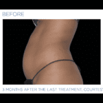 EMSCULPT-NEO-before-and-after-at-S-Thetics-Clinic-in-Beaconsfield-Buckinghamshire-