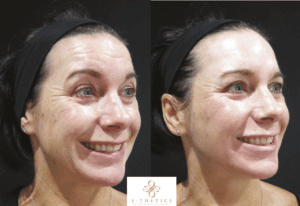 facial-fillers-before-and-after-at-S-Thetics-Clinic-Beaconsfield-Miss-Sherina-Balaratnam-Allergan-Faculty-Doctor