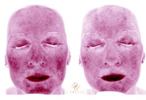 rosacea-before-and-after-at-S-Thetics-Clinic-Beaconsfield-Miss-Sherina-Balaratnam-Allergan-Faculty-Doctor