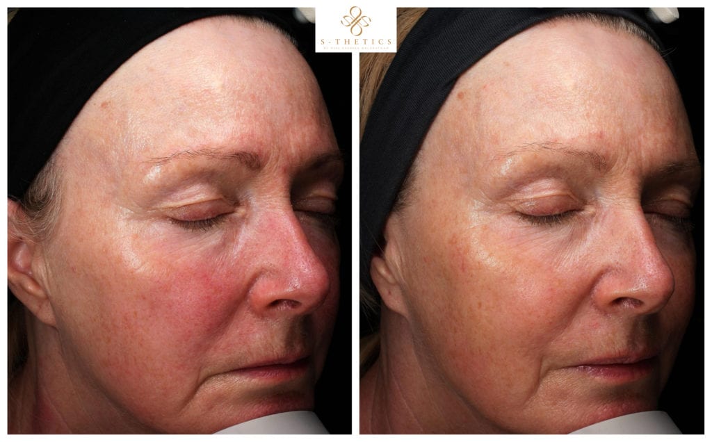 before-and-after-results-at-S-Thetics-Skin-Clinic-in-Beaconsfield-healthy-skin