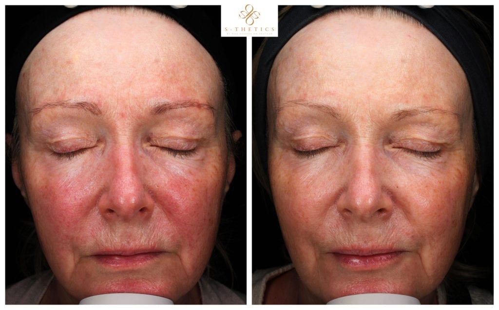 before-and-after-results-at-S-Thetics-Skin-Clinic-in-Beaconsfield-healthy-skin-reduce-facial-redness