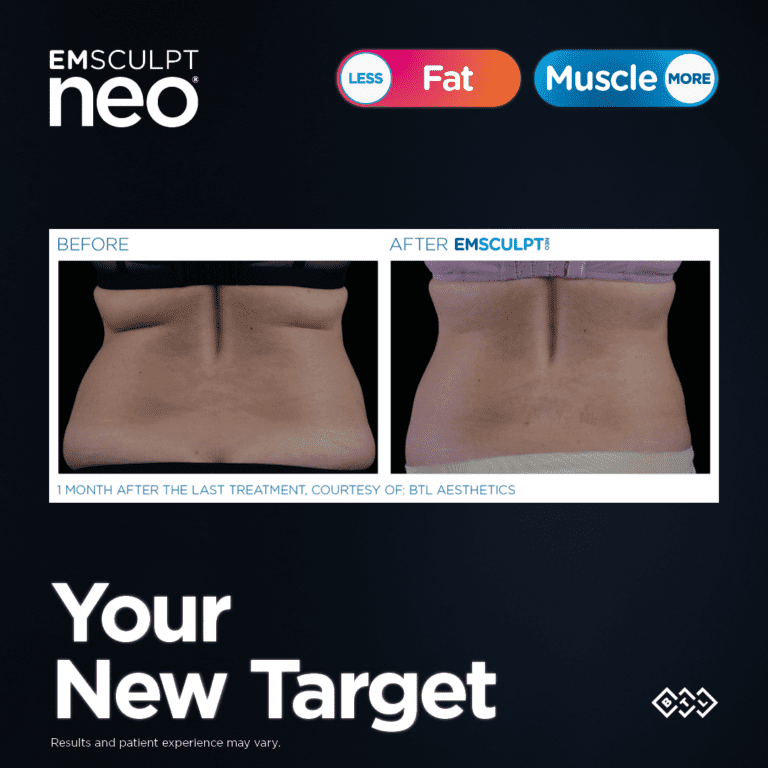 EMSCULPT NEO EDGE Flank Applicators Launch at SThetics Clinic 28.09.