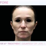 emface-before-and-after-at-s-thetics-clinic-in-beaconsfield7