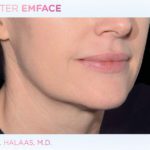 emface-before-and-after-at-s-thetics-clinic-in-beaconsfield8