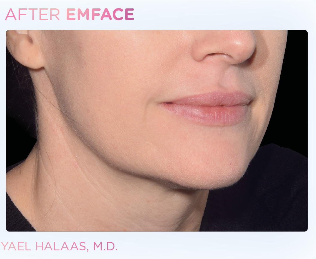 emface-before-and-after-at-s-thetics-clinic-in-beaconsfield4