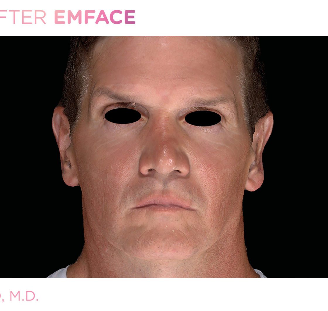 emface-before-and-after-at-s-thetics-clinic-in-beaconsfield6