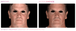 emface-before-and-after-photos-at-s-thetics-clinic-in-beaconsfield-buckinghamshire12