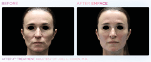 emface-before-and-after-photos-at-s-thetics-clinic-in-beaconsfield-buckinghamshire3
