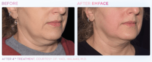 emface-before-and-after-photos-at-s-thetics-clinic-in-beaconsfield-buckinghamshire5